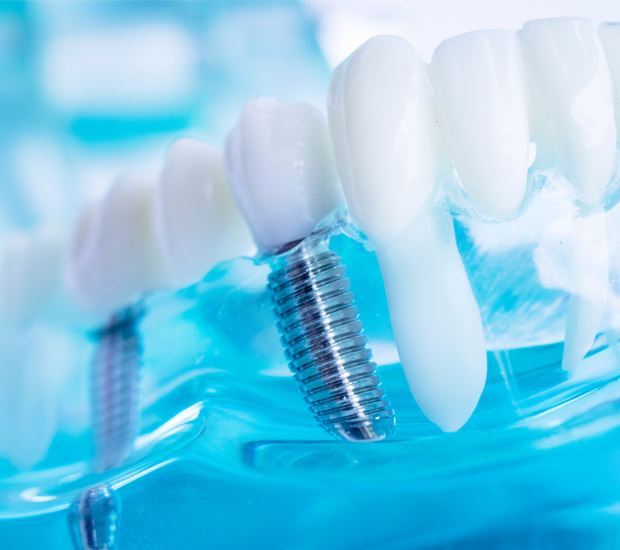 San Diego Will I Need a Bone Graft for Dental Implants