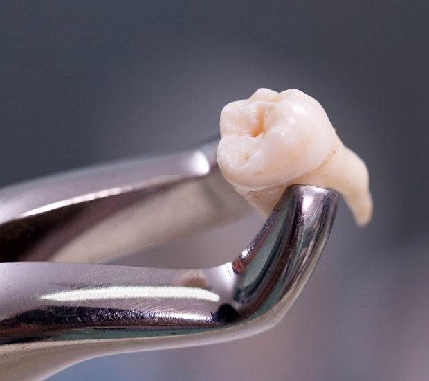 San Diego Wisdom Teeth Extraction